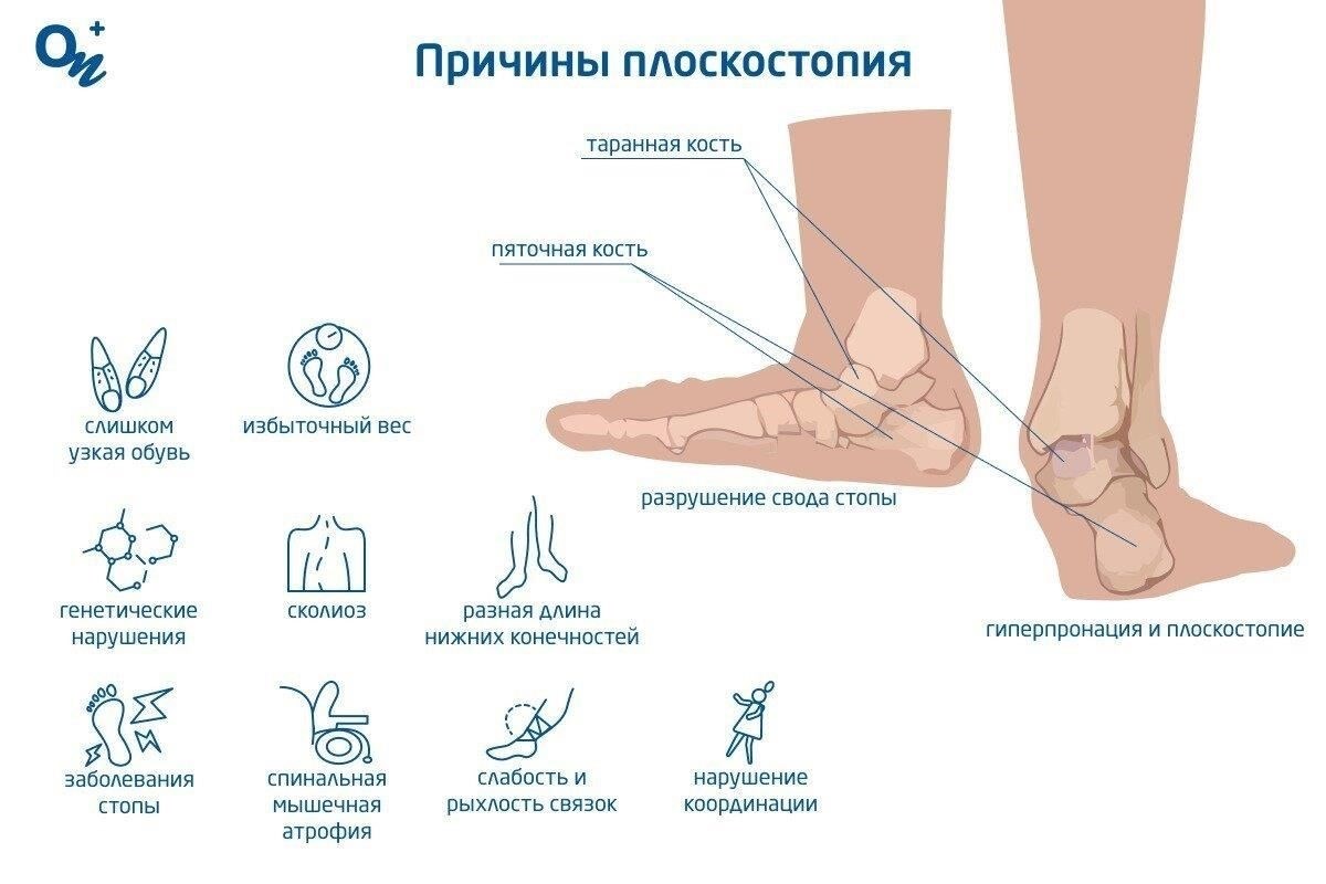 Что такое плоскостопие? Понимание этого состояния