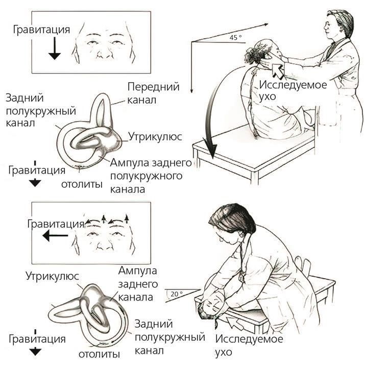 Кроме того, доброкачественное пароксизмальное позиционное головокружение (ДППВ) - еще одно заболевание, которое необходимо отличать от лабиринтных расстройств. BPPV обычно проявляется внезапными, короткими приступами головокружения, вызванными определенными движениями головы, без сопутствующего снижения слуха или ушной полноты. Ключевое различие заключается в характере и провоцирующих факторах эпизодов головокружения.