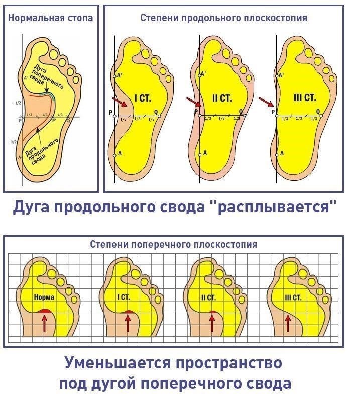 Наличие плоскостопия может повлиять на вашу пригодность к военной службе, в зависимости от степени тяжести заболевания. Военные правила различаются, но в целом влияние этого состояния на общую пригодность к службе зависит от его степени и от того, вызывает ли оно значительные нарушения.